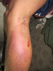 Stle Lin Shwe’s bruised leg after the accident.